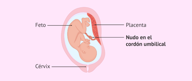 Imagen: ¿Es peligroso un nudo en el cordón umbilical?