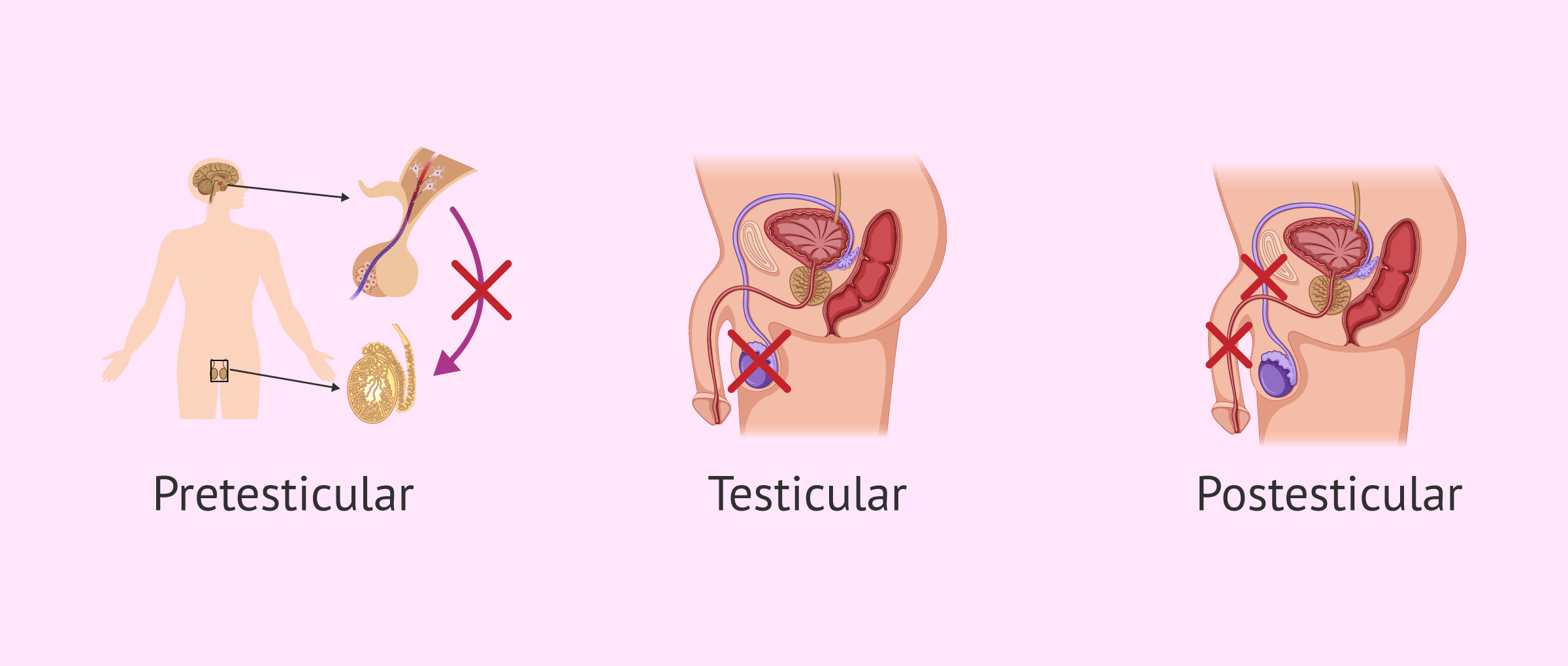 ¿Cuáles son las principales causas de la azoospermia?