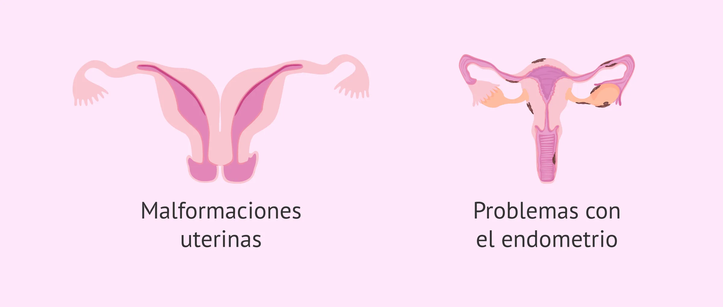 Imagen: Motivos uterinos de esterilidad femenina