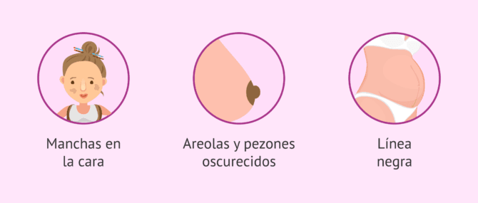 Imagen: Manchas en la piel en el embarazo