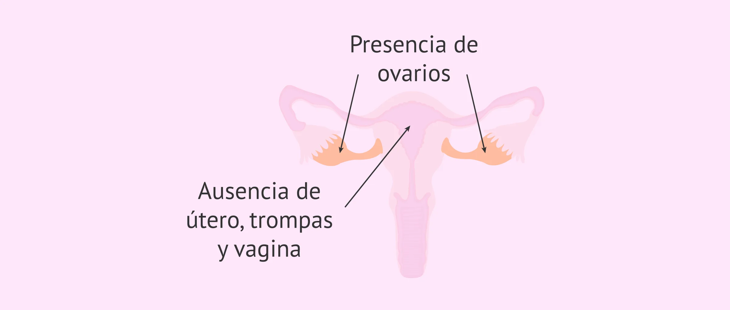 Imagen: ¿Qué es la agenesia uterina?