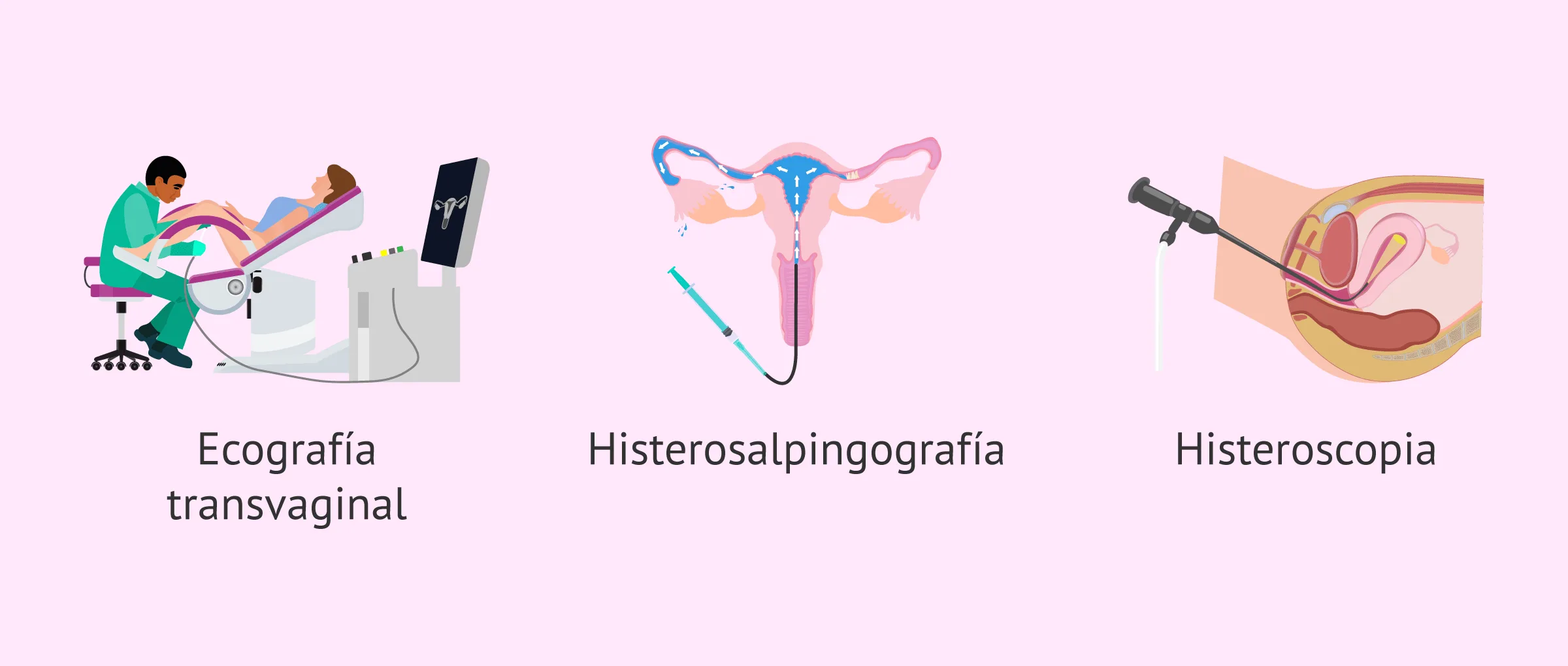 Imagen: Pruebas para el diagnóstico de malformaciones uterinas