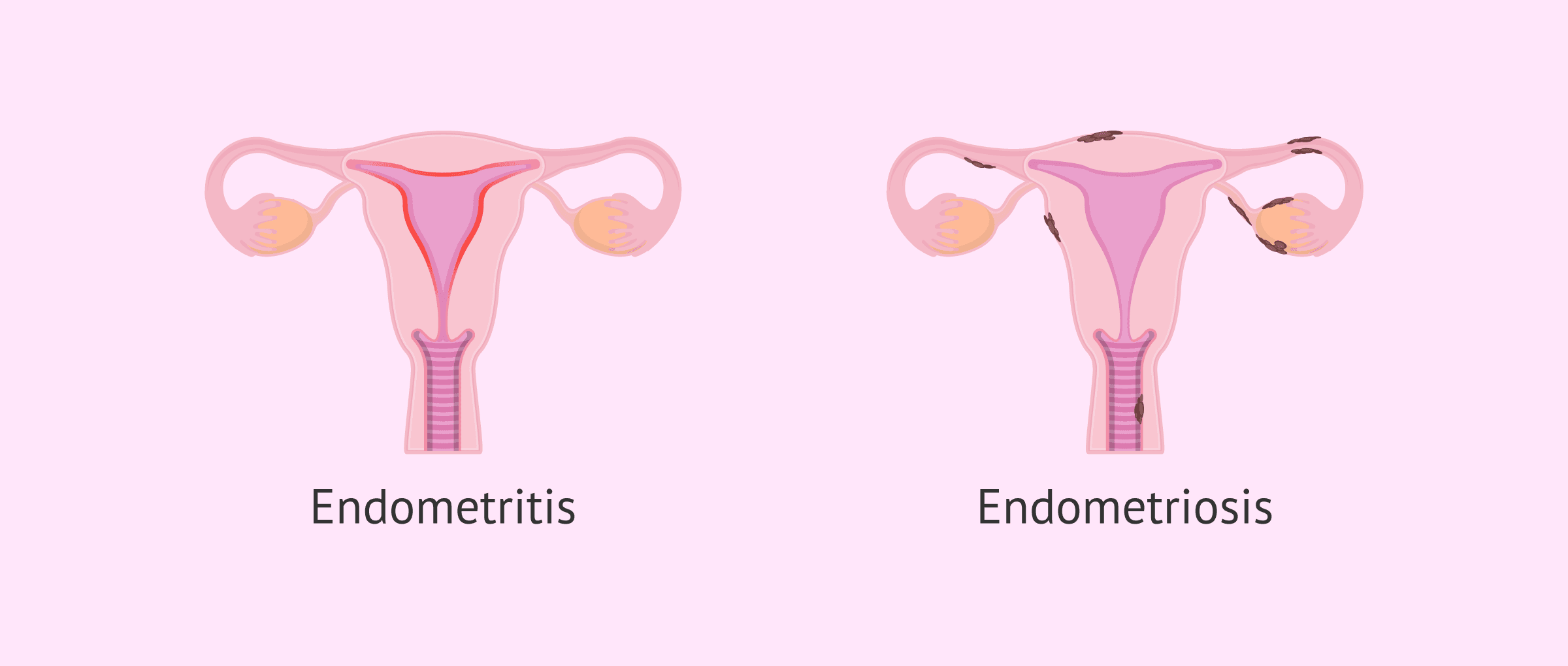 ¿Qué produce la endometritis? ¿Cómo se diagnostica y se trata?
