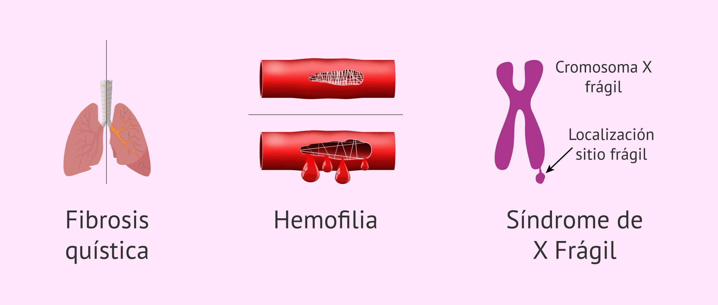 Imagen: Ejemplos de enfermedades monogénicas