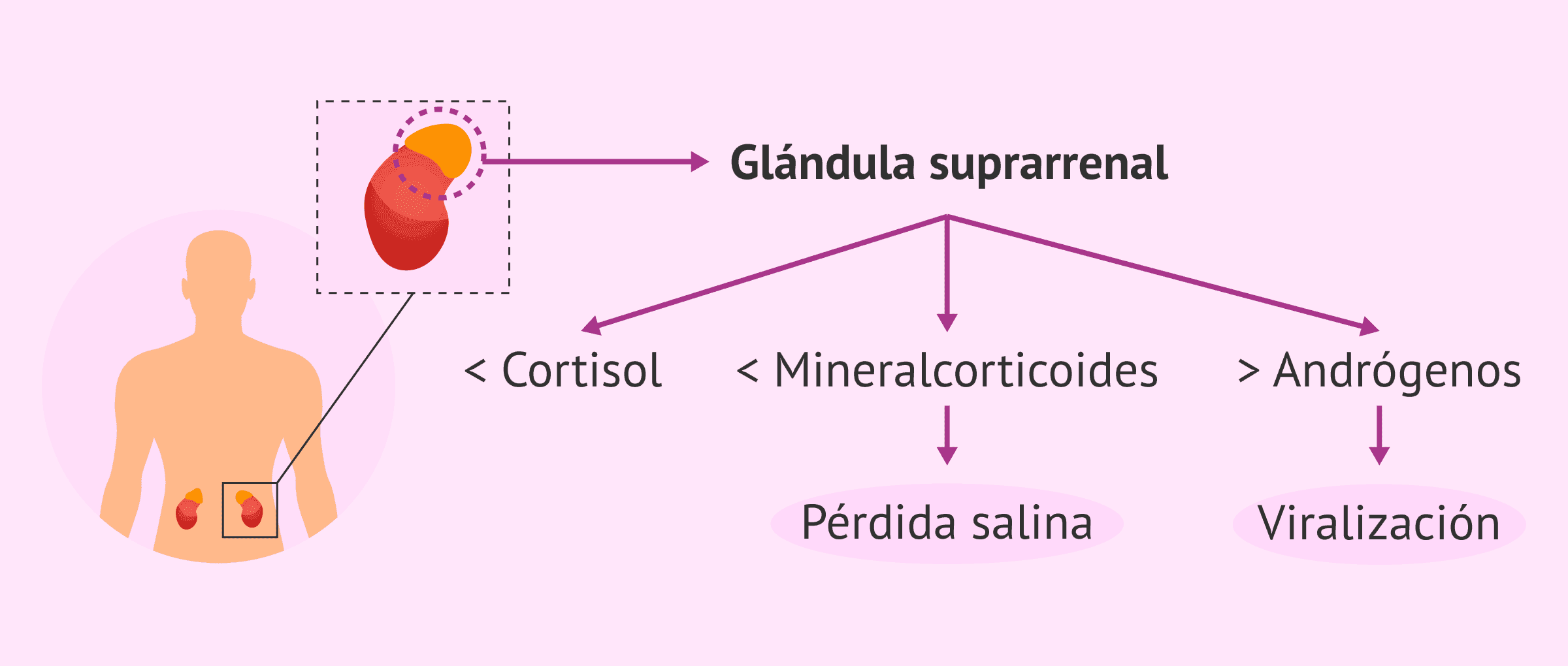 Imagen: Fisiopatología de la hiperplasia suprarrenal congénita