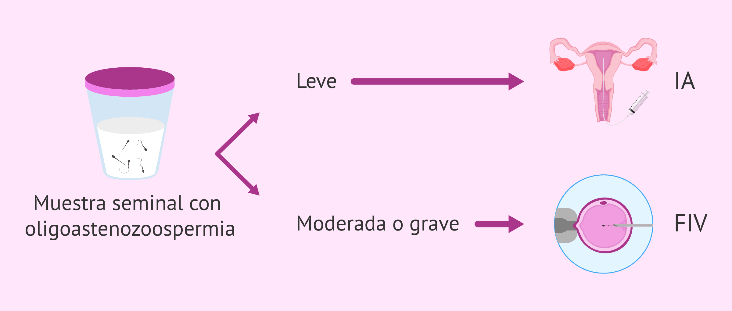 Imagen: Tratamientos reproductivos para lograr el embarazo con oligoastenozoospermia
