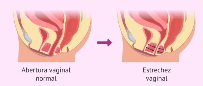 Imagen: El vaginismo y la dispareunia pueden ser recíprocos