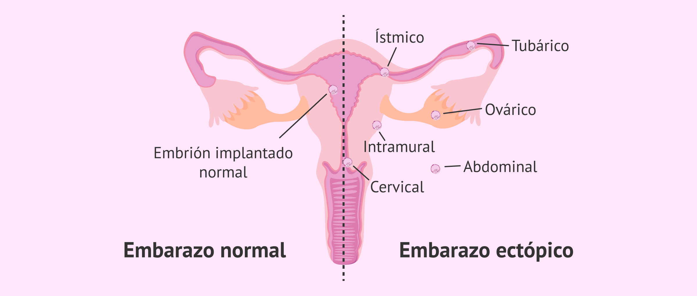 ¿Qué es el embarazo ectópico? - Tipos, síntomas y diagnóstico