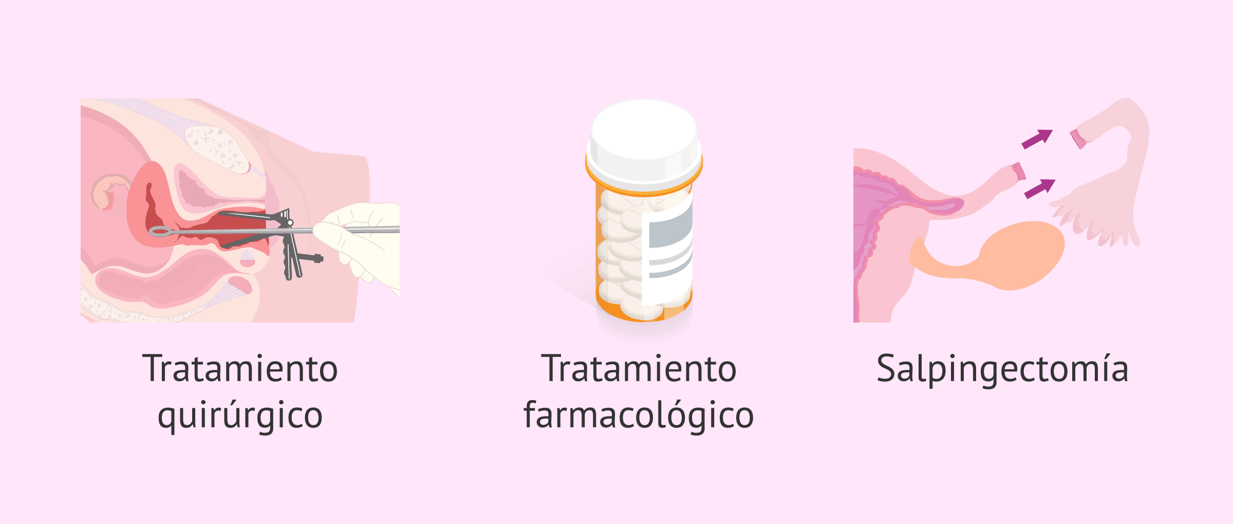 Imagen: Formas de tratar un embarazo ectópico