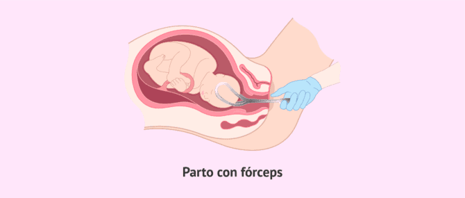 Imagen: El parto con forceps