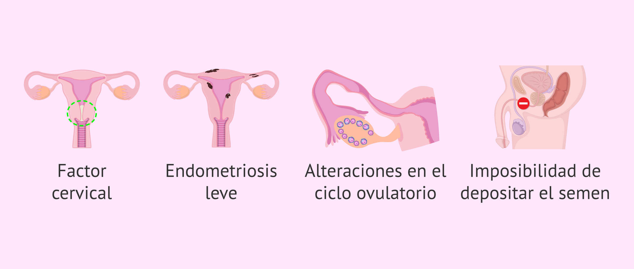 Imagen: ¿Cuándo está indicada la IA conyugal?