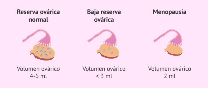 Imagen: Volumen del ovario y reserva ovárica