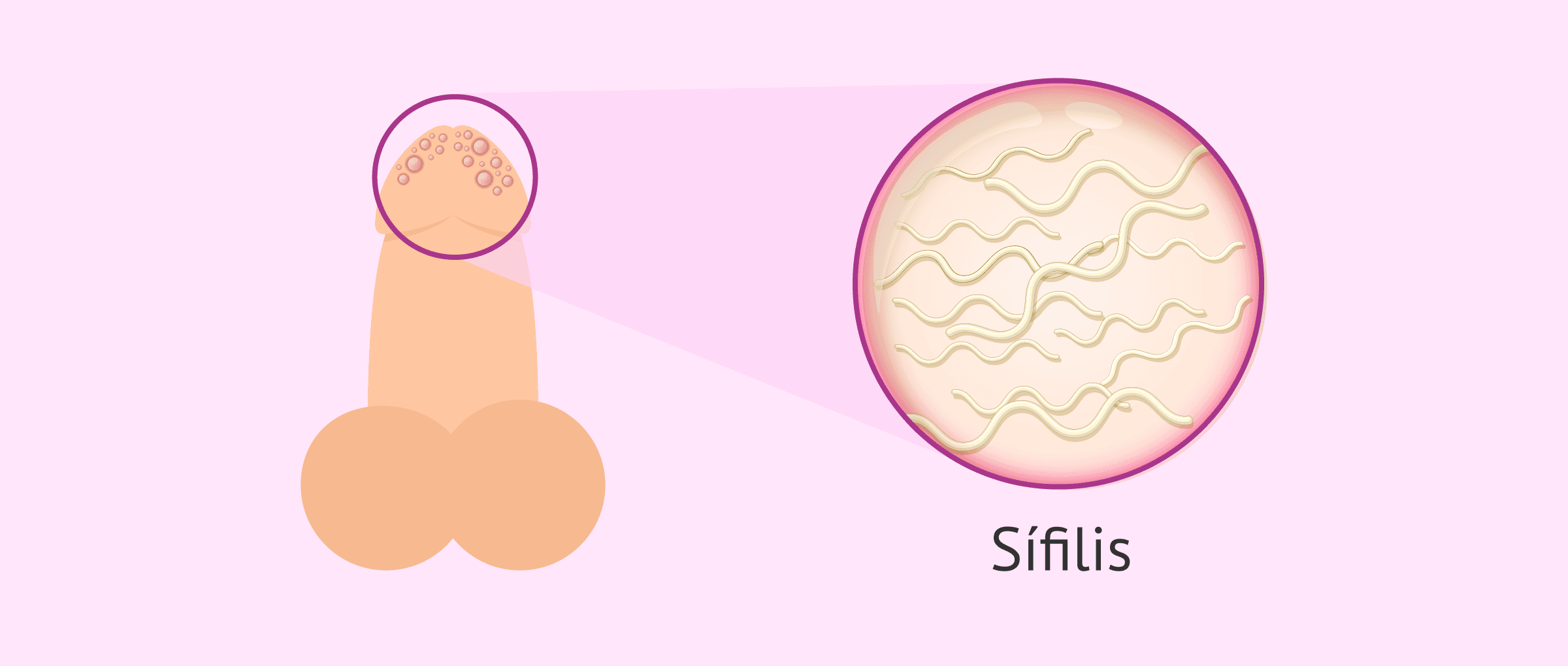 Imagen: Definición de sífilis