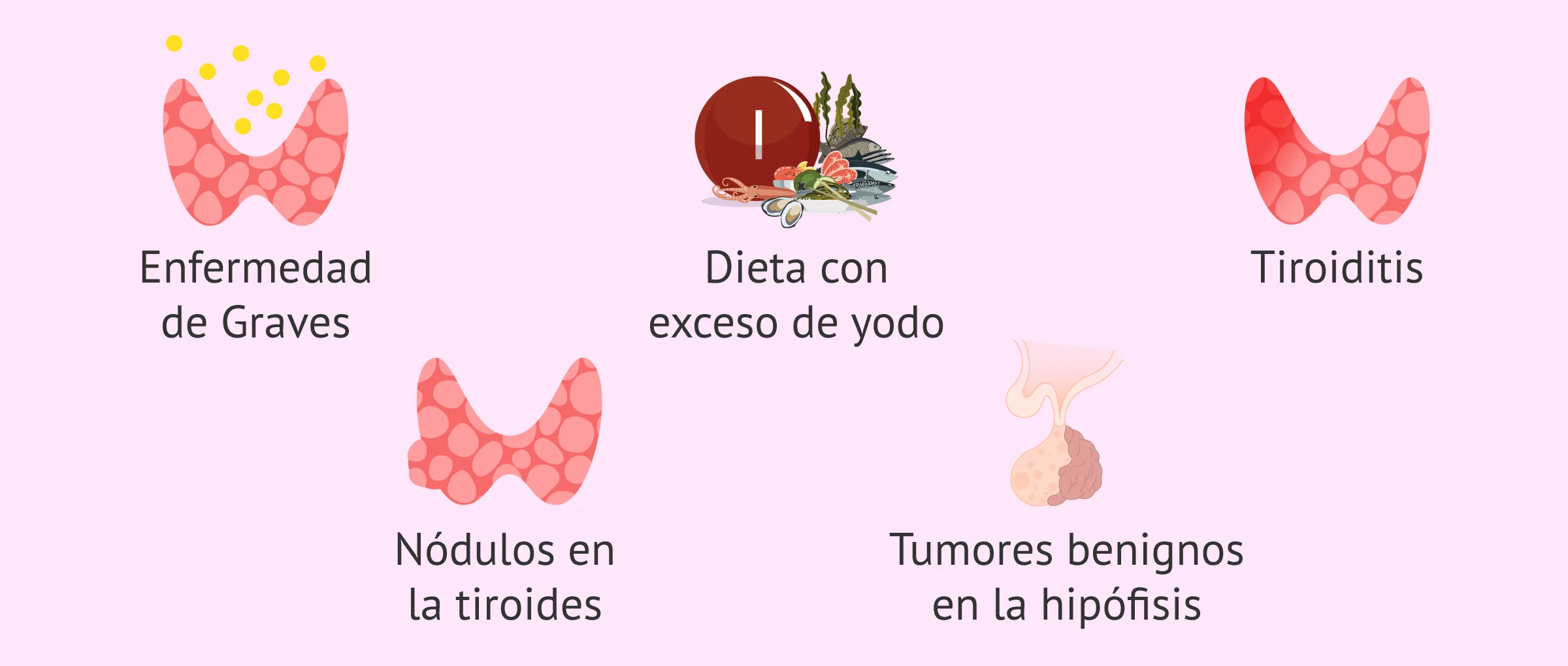 Causas del hipertiroidismo