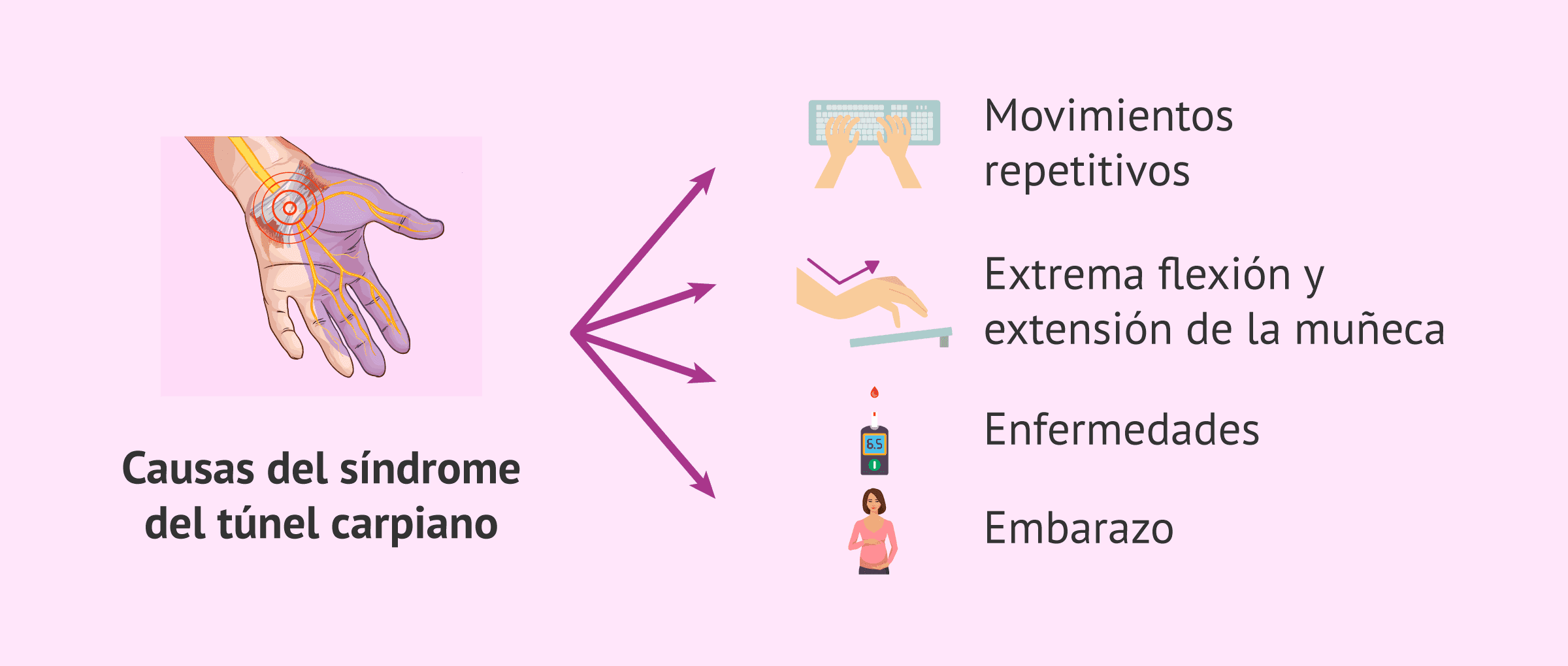 ¿Por qué surge el síndrome del túnel carpiano?