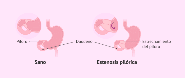 La estenosis pilórica en los bebés: síntomas, causas y tratamiento
