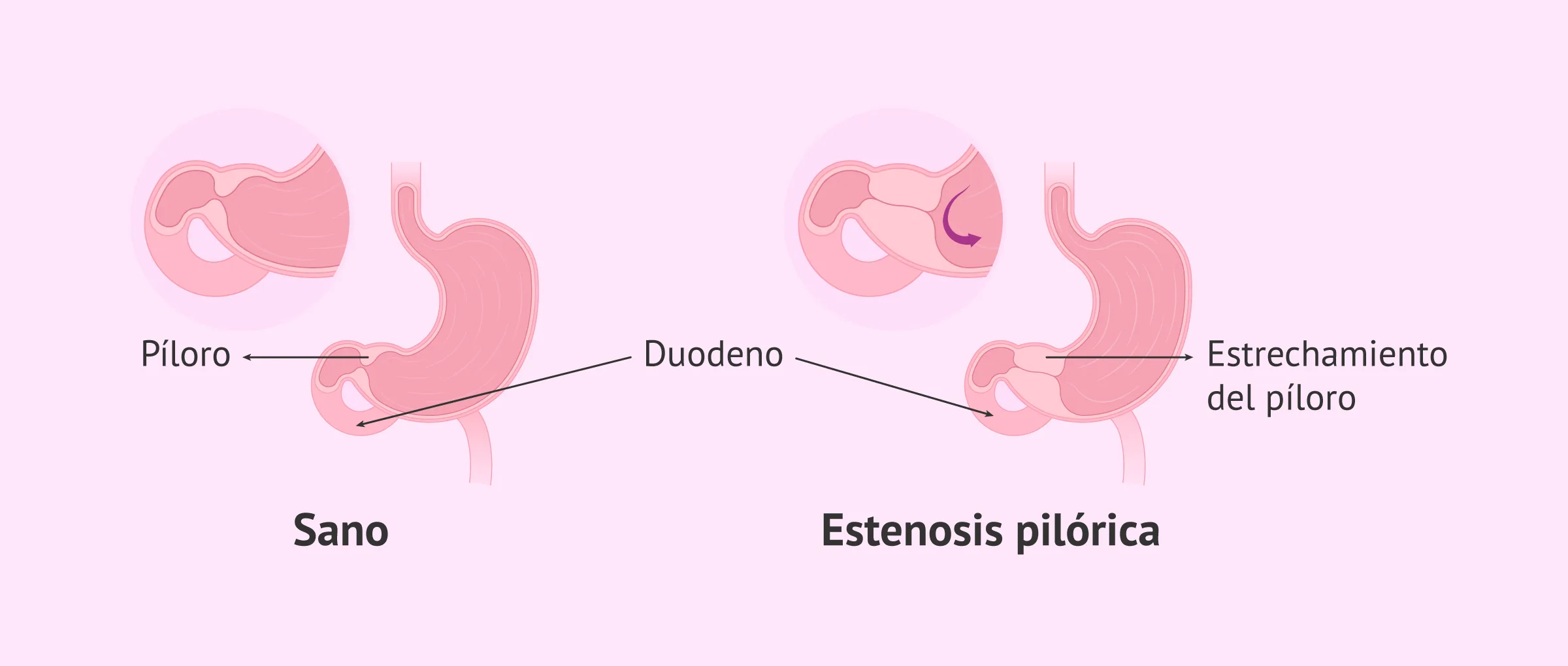 Definición de estenosis pilórica