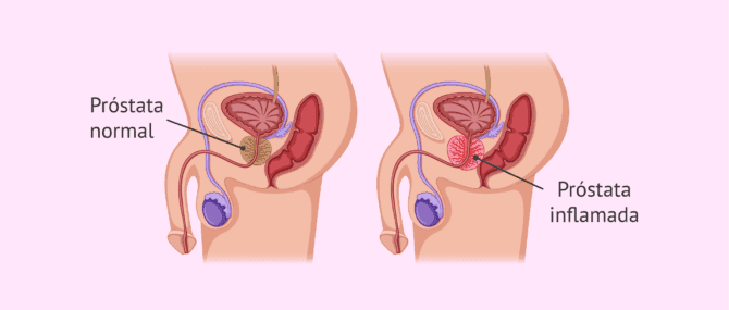 Imagen: Próstata inflamada