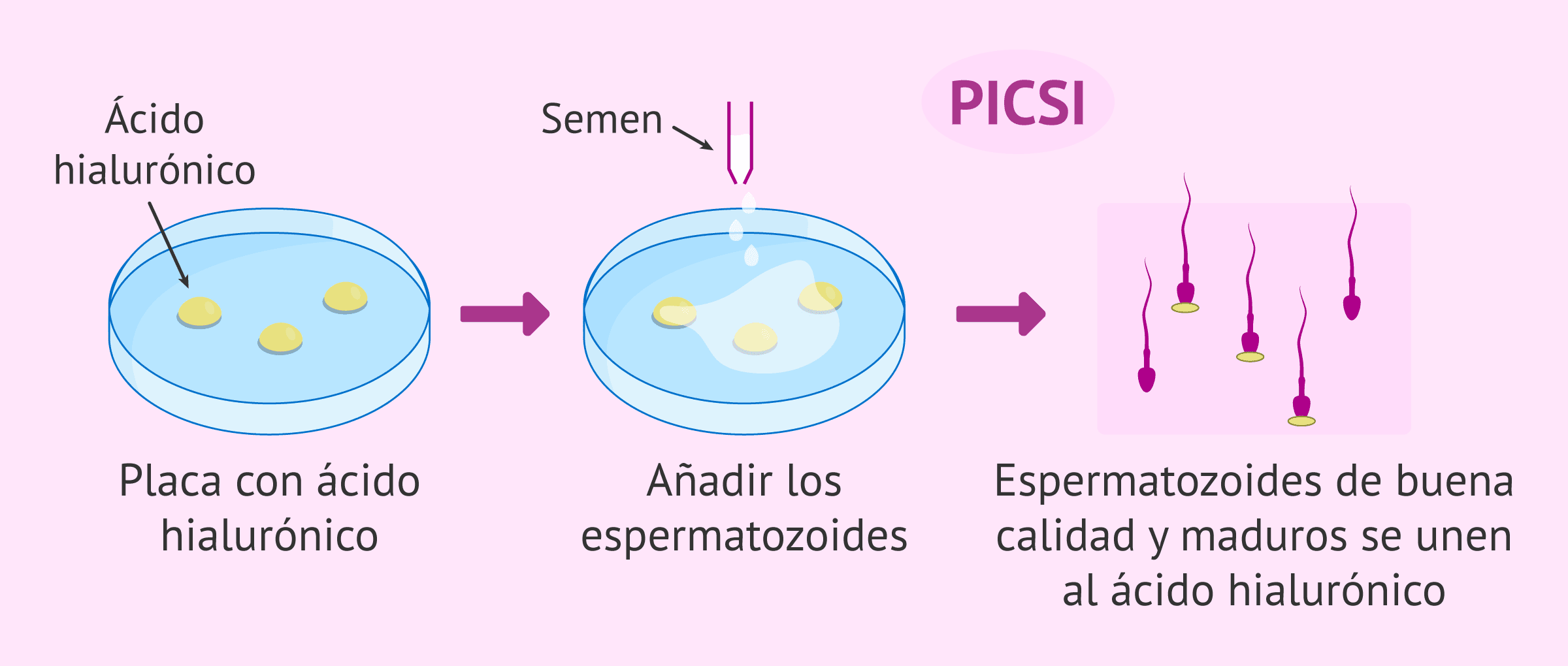 Imagen: ¿En qué consiste el PICSI o ICSI fisiológico?