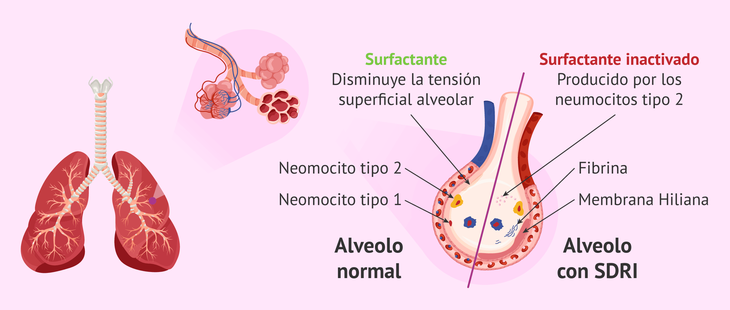 Imagen: ¿Cómo afecta el distrés respiratorio tipo I?
