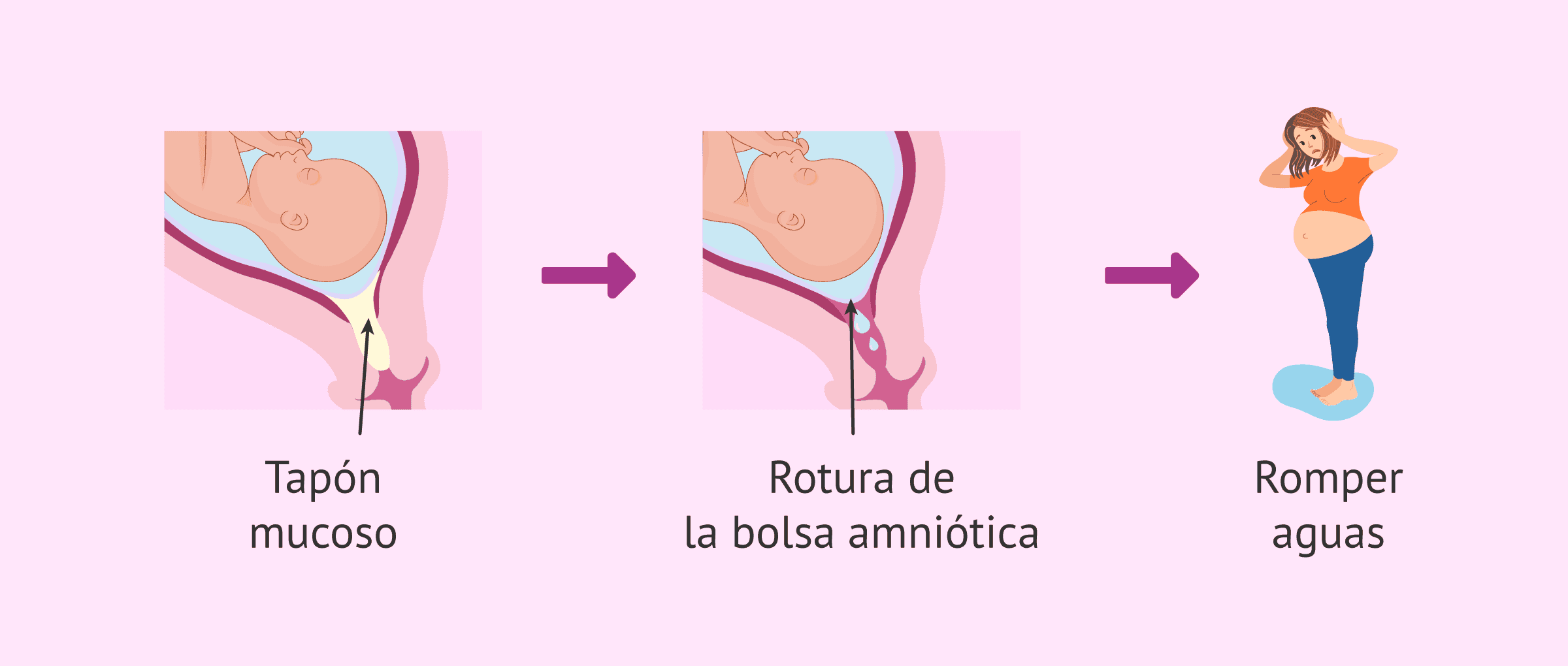 Imagen: Rotura de aguas hasta el parto