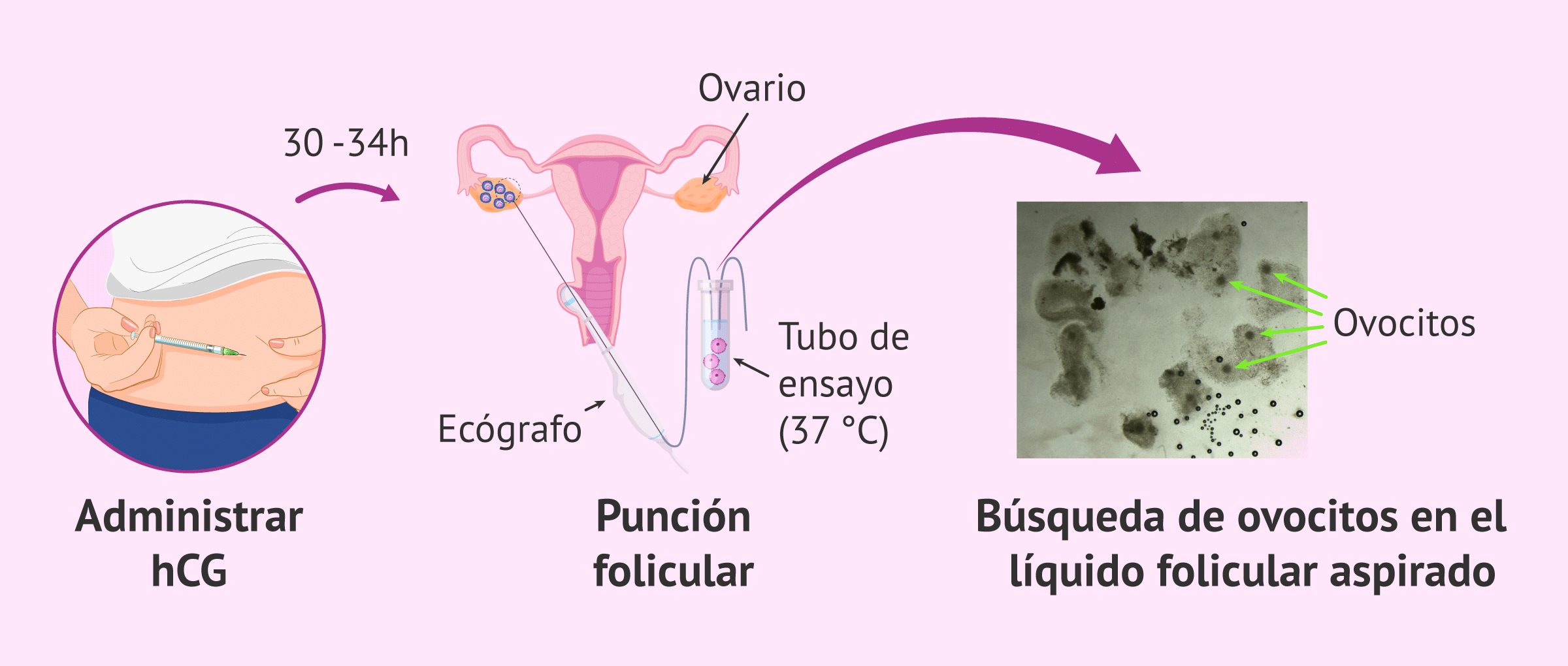Imagen: ¿Cómo se realiza la punción folicular?