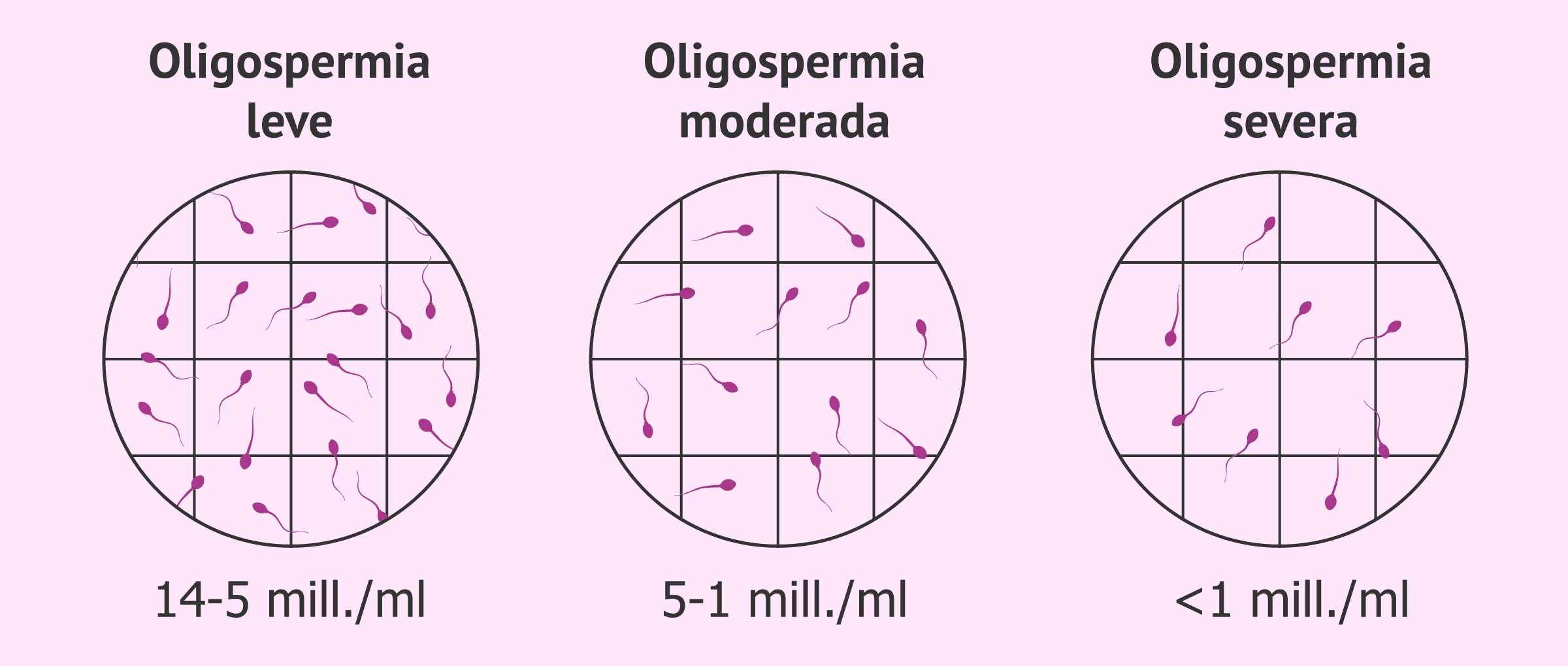 Los tipos de oligospermia: leve, moderada y severa