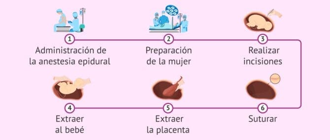 Imagen: Intervención de cesárea para dar a luz