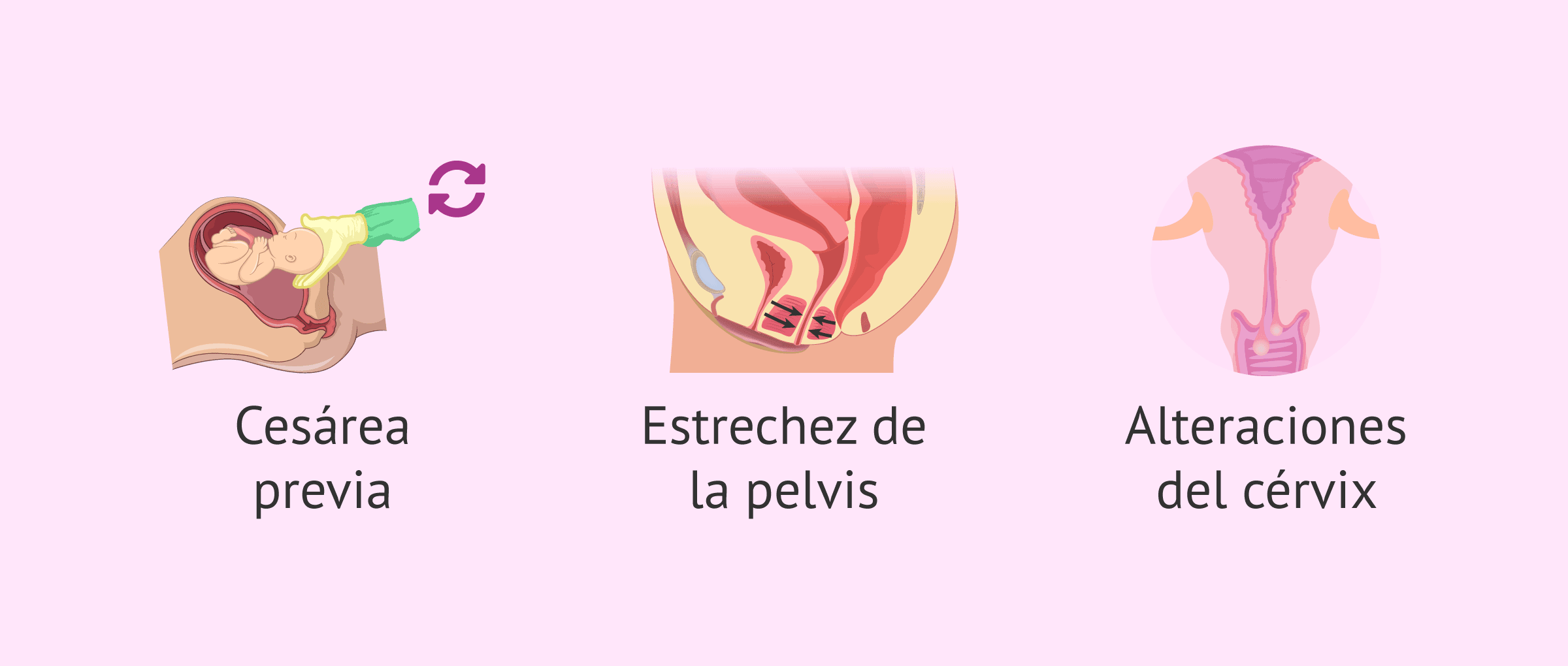 Imagen: Situaciones recomendadas para hacer una cesárea