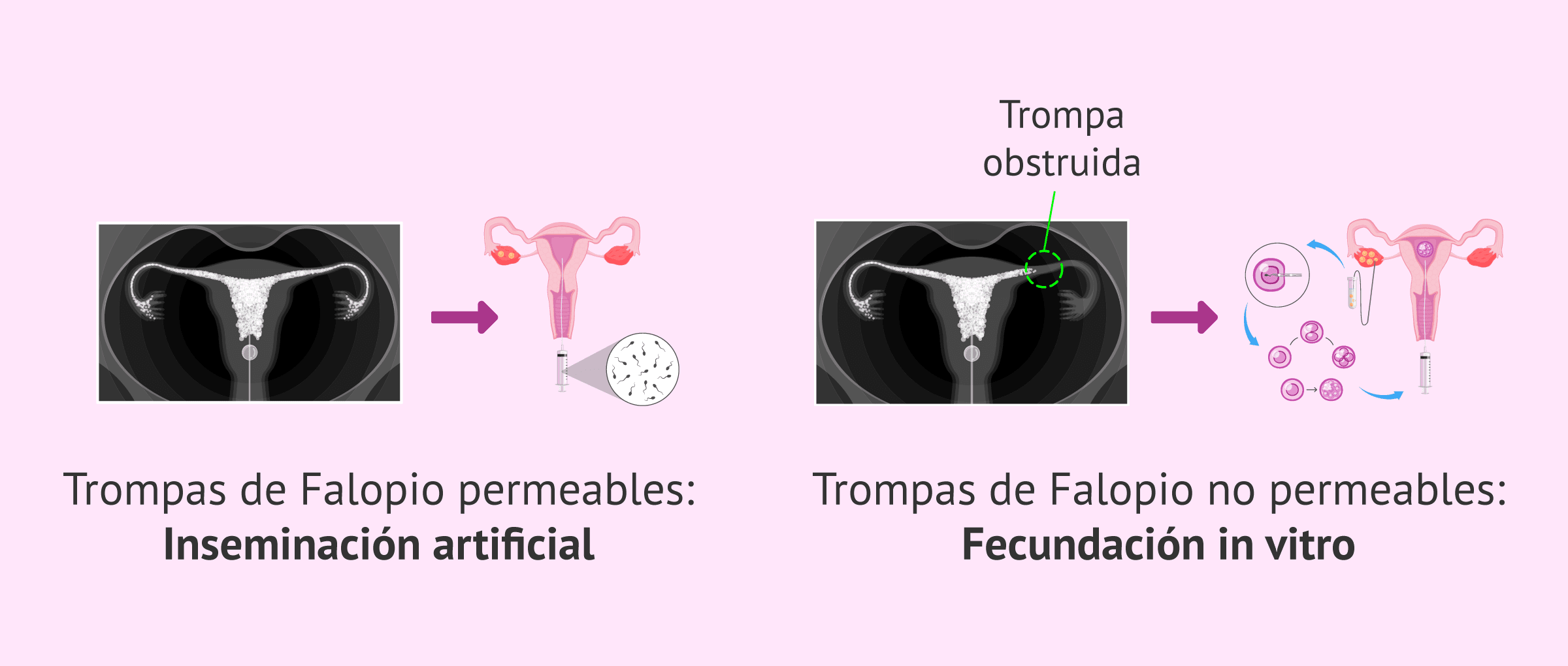 Imagen: Tratamiento de fertilidad según el resultado de la HSG