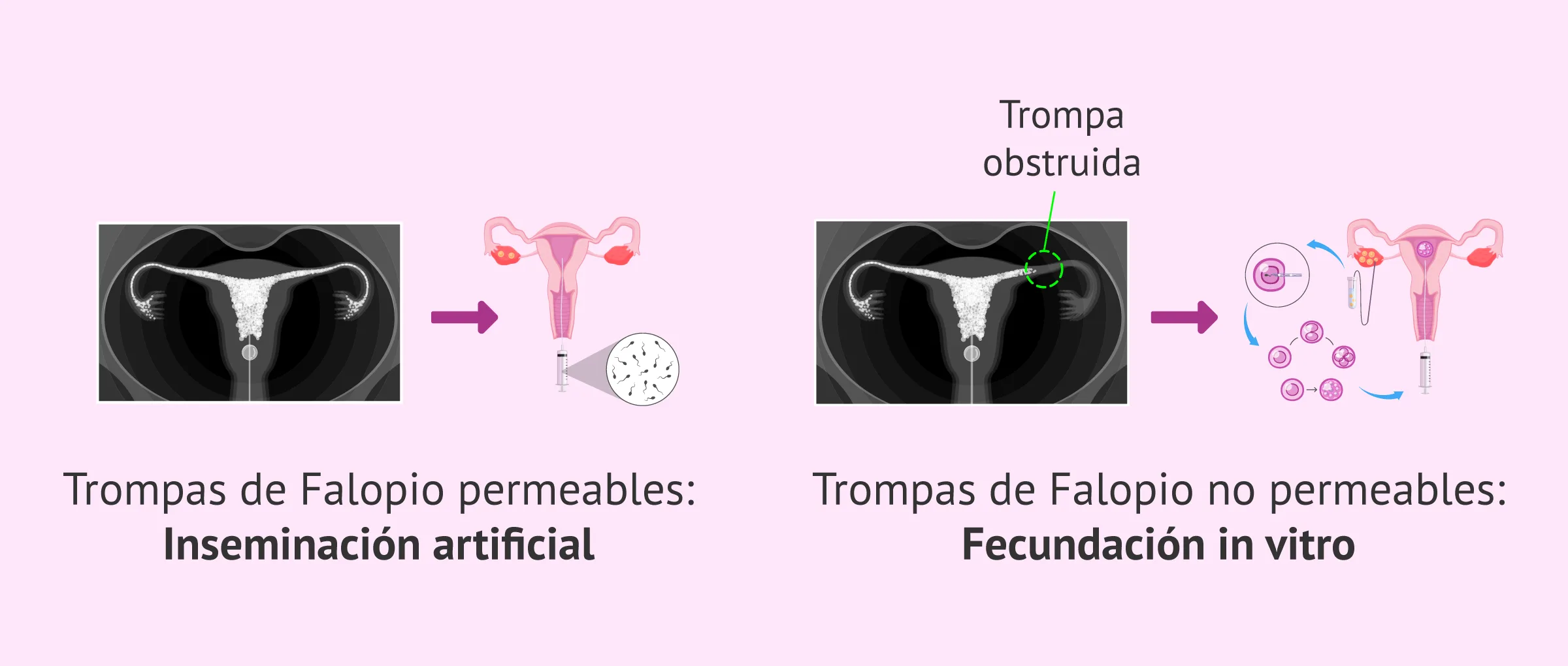 Tratamiento de fertilidad según el resultado de la HSG