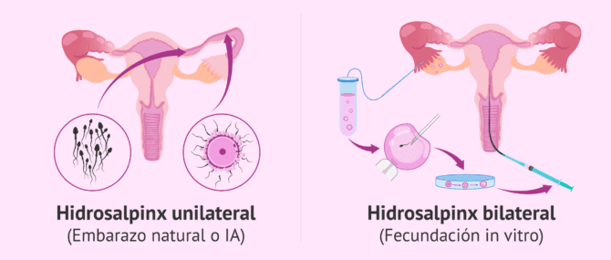 Imagen: Embarazo con hidrosalpinx