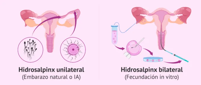 Imagen: Embarazo con hidrosalpinx