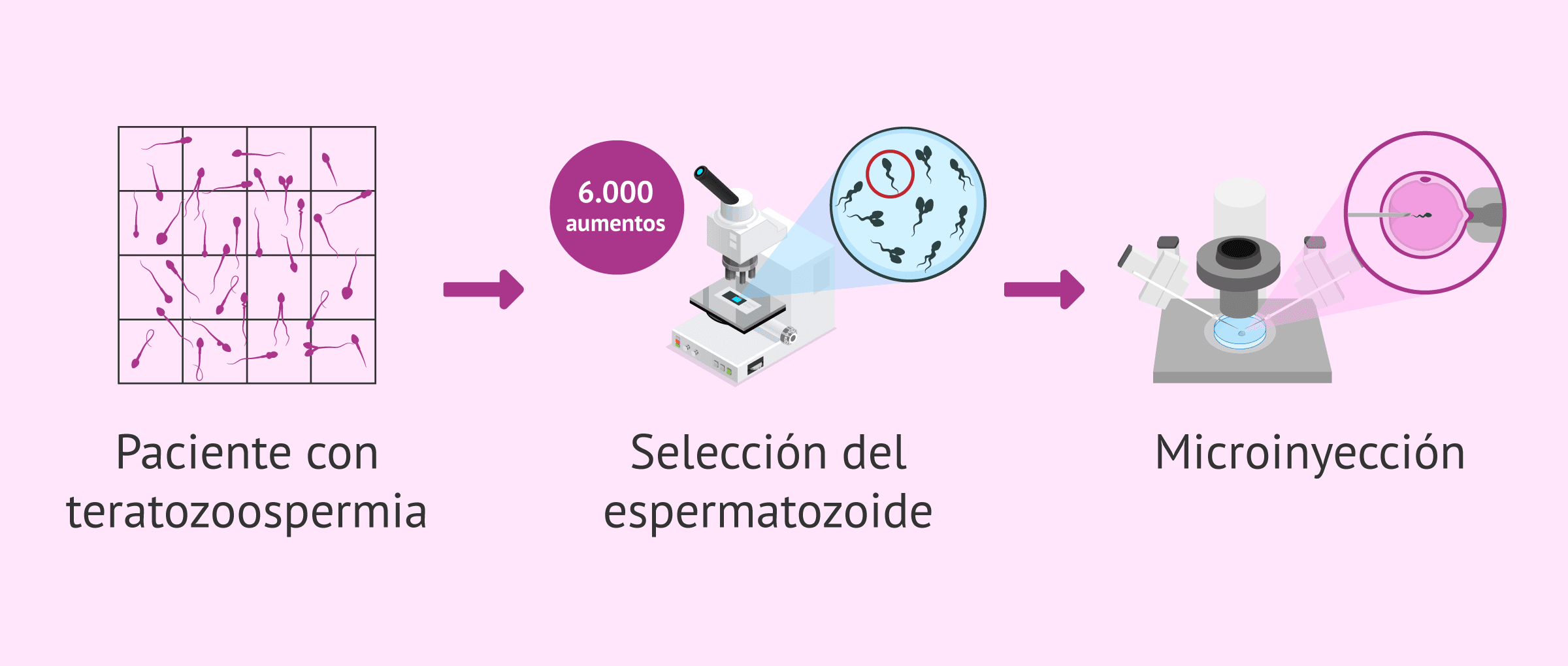 Imagen: Técnica de IMSI para la selección de espermatozoides