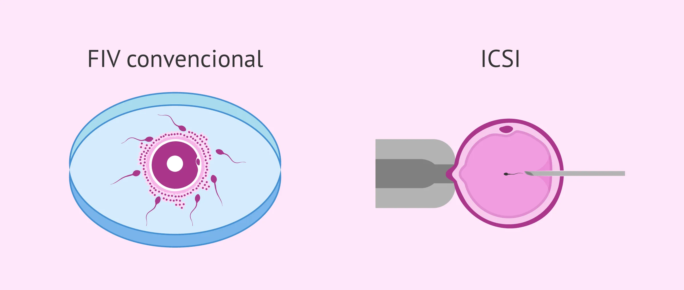 La fecundación in vitro (FIV)