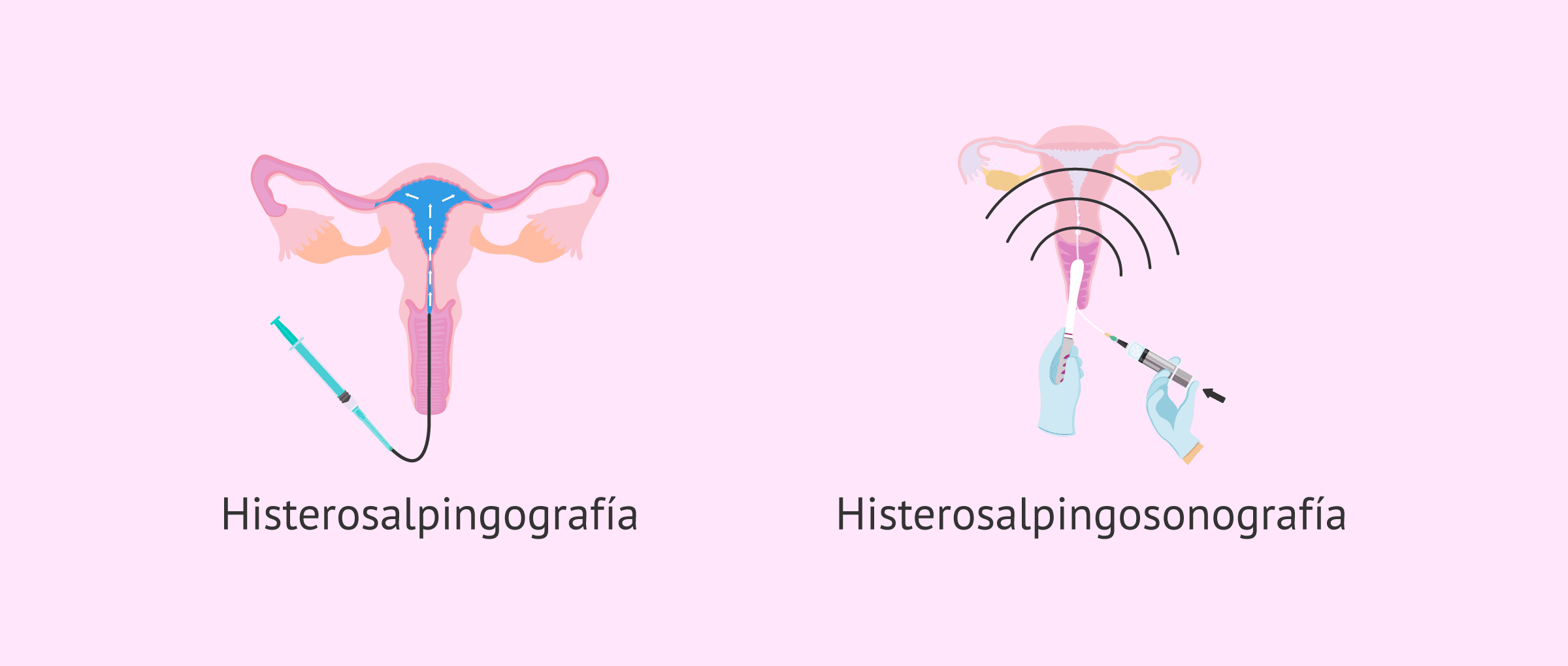 Imagen: Pruebas para comprobar la permeabilidad tubárica