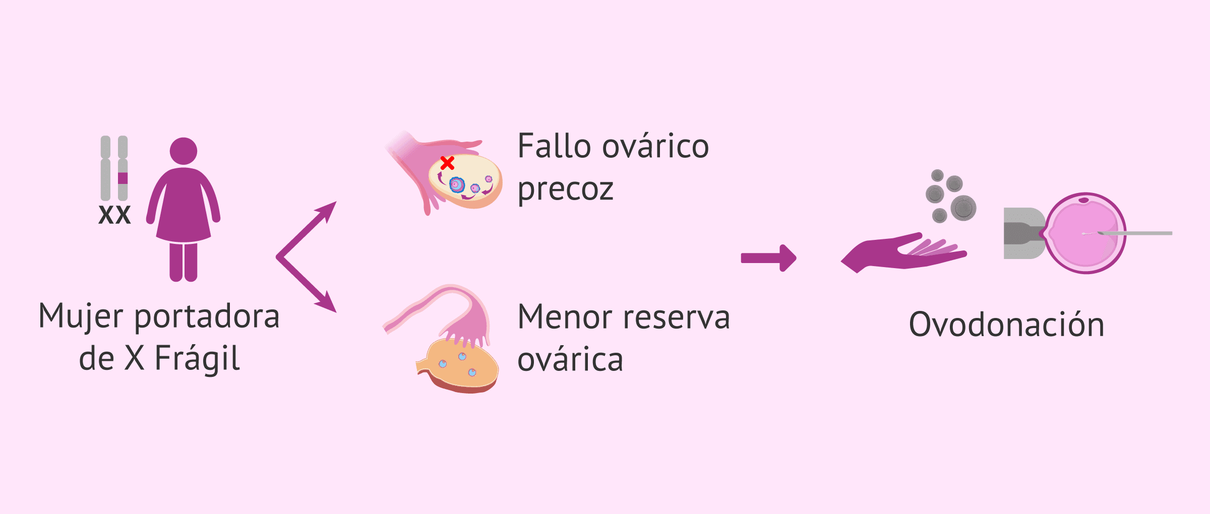 Imagen: Opción de lograr un embarazo en mujeres portadoras de X Frágil y baja reserva