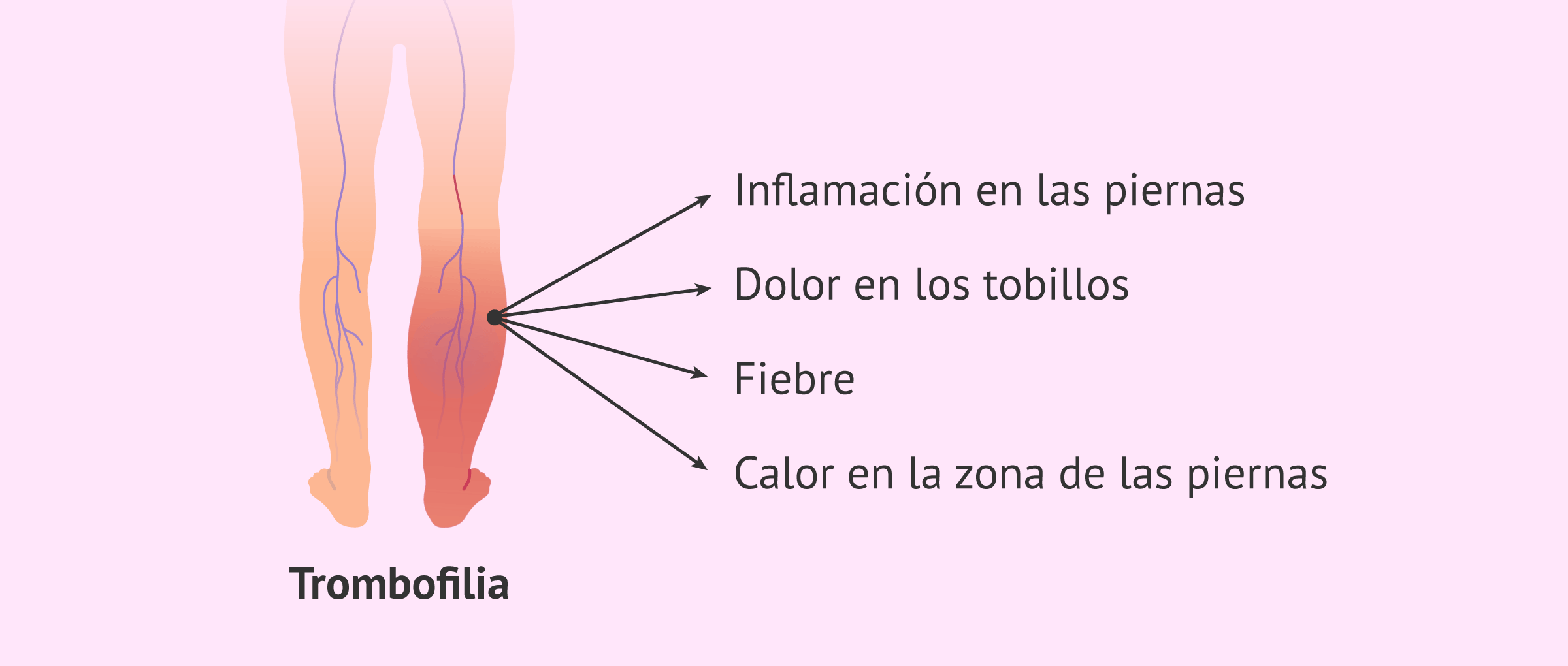 Imagen: Síntomas de un posible trombo