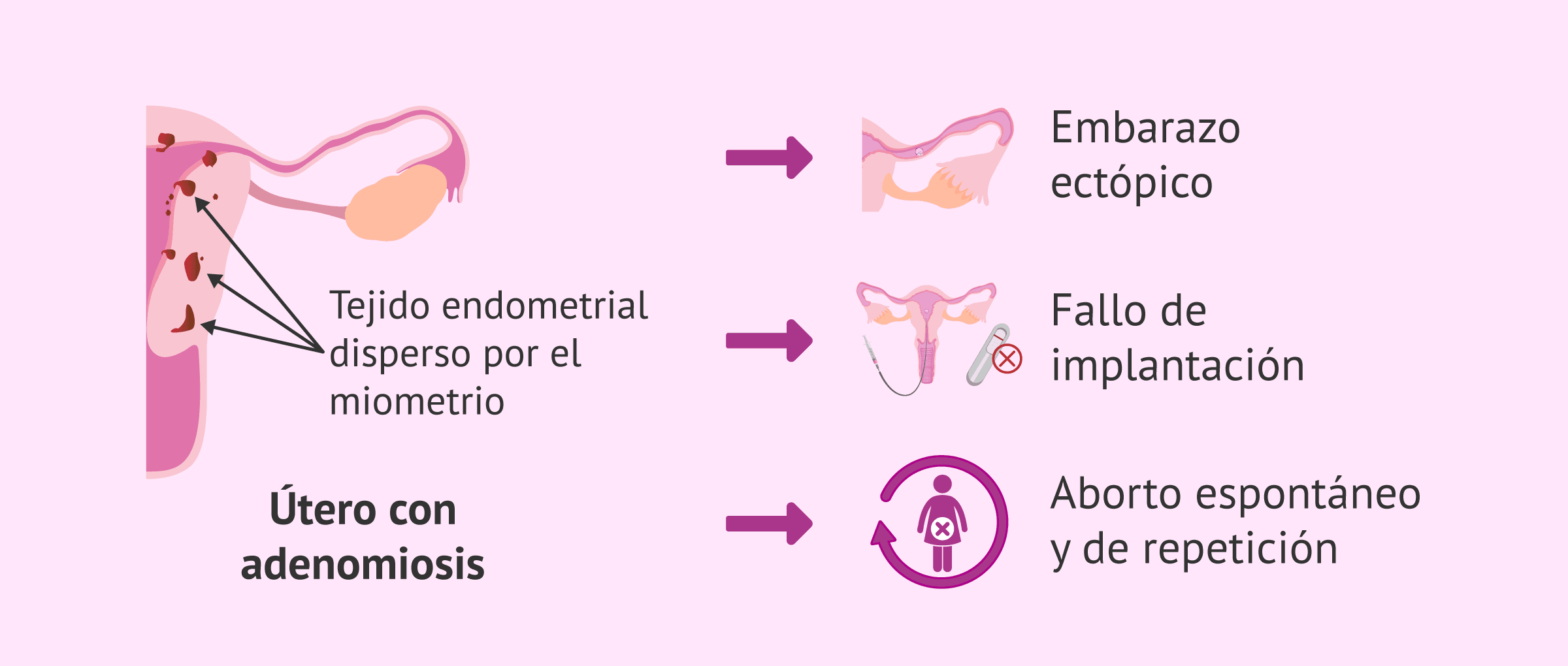 Imagen: Consecuencias en el embarazo por la adenomiosis