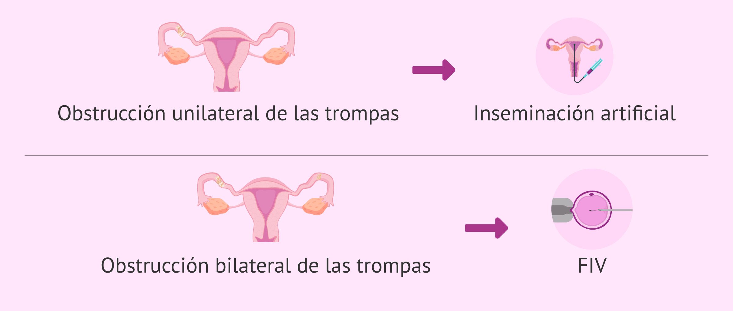 Imagen: Tratamientos de fertilidad ante una obstrucción tubárica