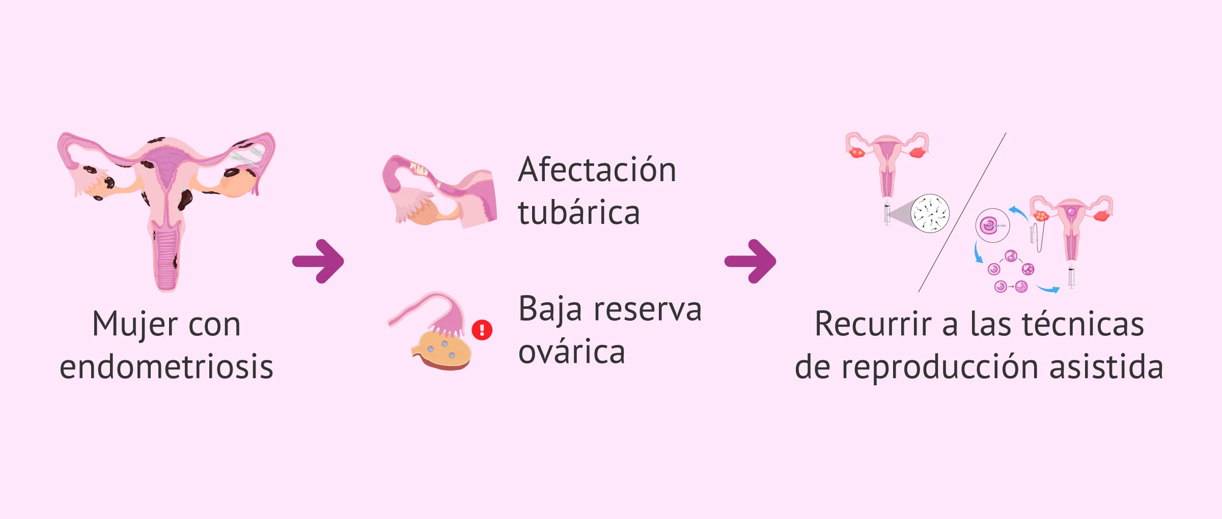 Imagen: Afectación de la fertilidad por endometriosis