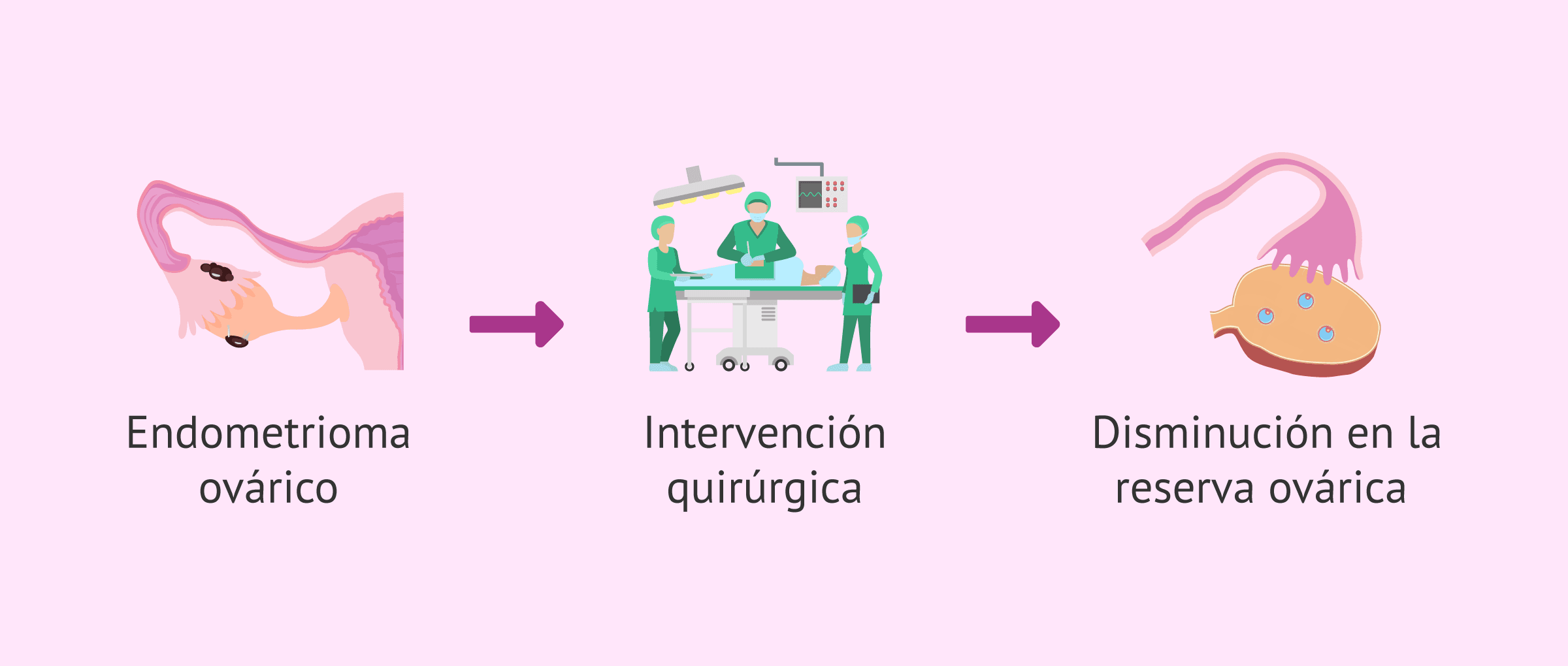 Cirugía de endometrioma: técnicas que cuidan la reserva ovárica