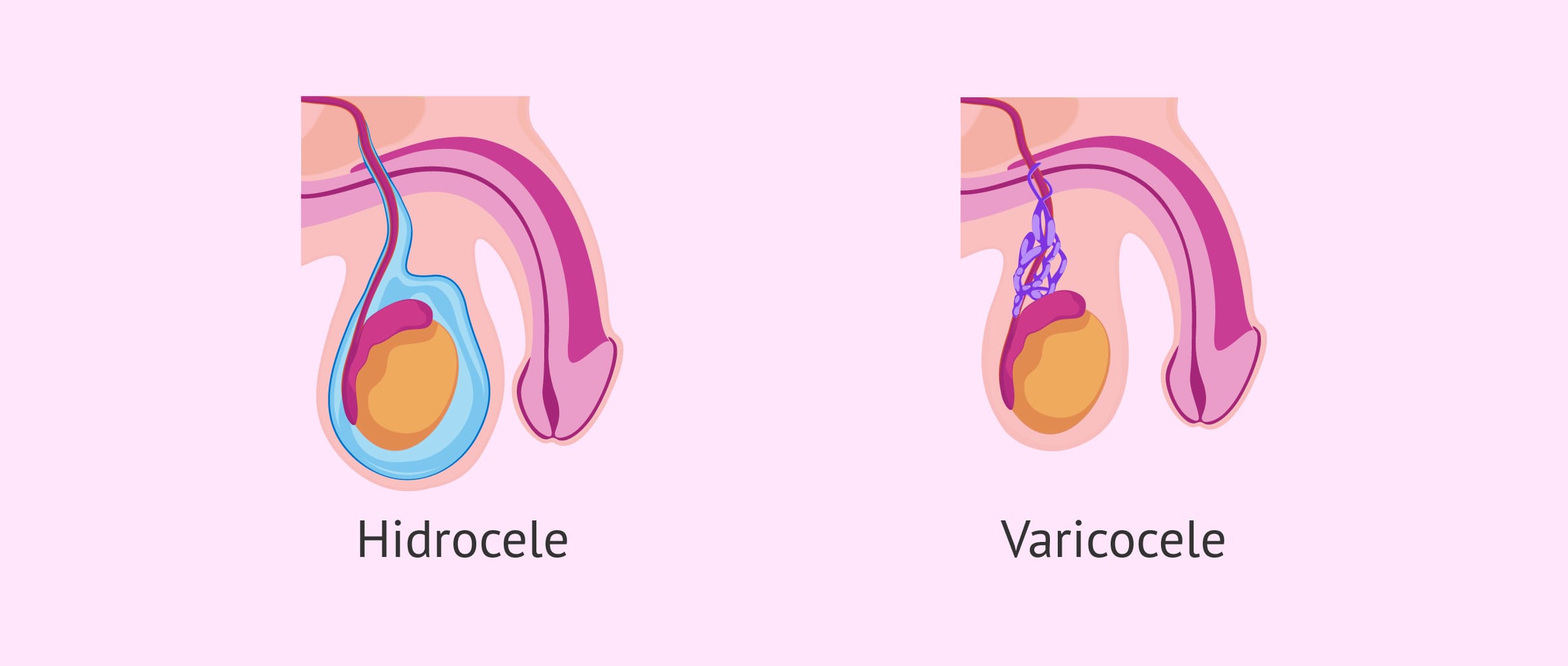 Imagen: Diferencias entre hidrocele y varicocele