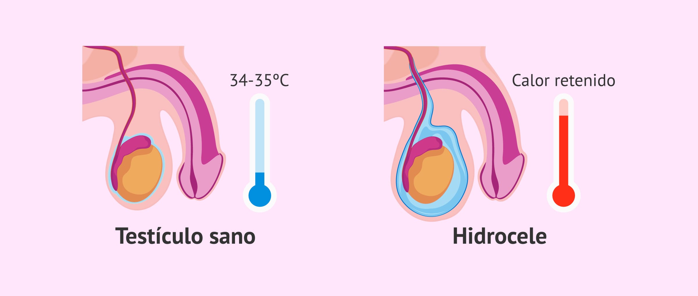 Mito médico: ¿el hidrocele afecta o no a la fertilidad del varón?