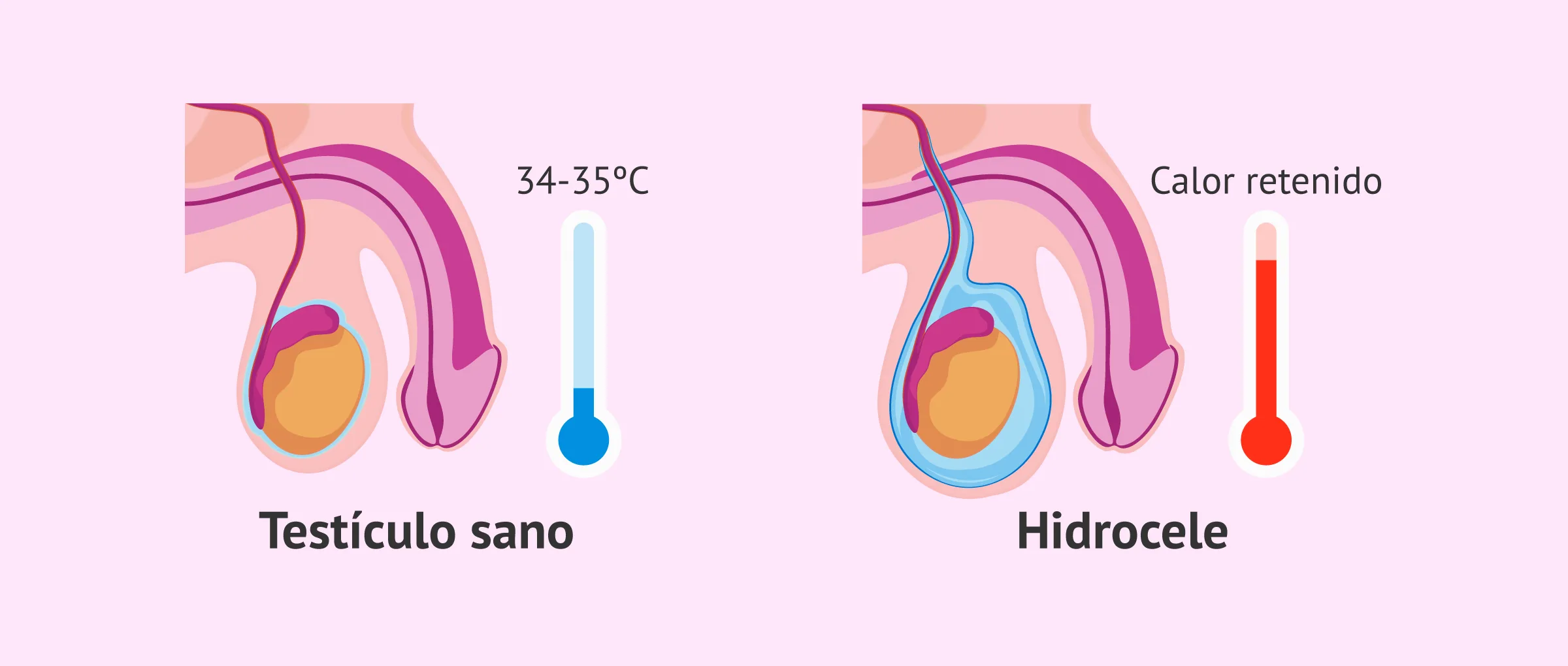Mito médico: ¿el hidrocele afecta o no a la fertilidad del varón?