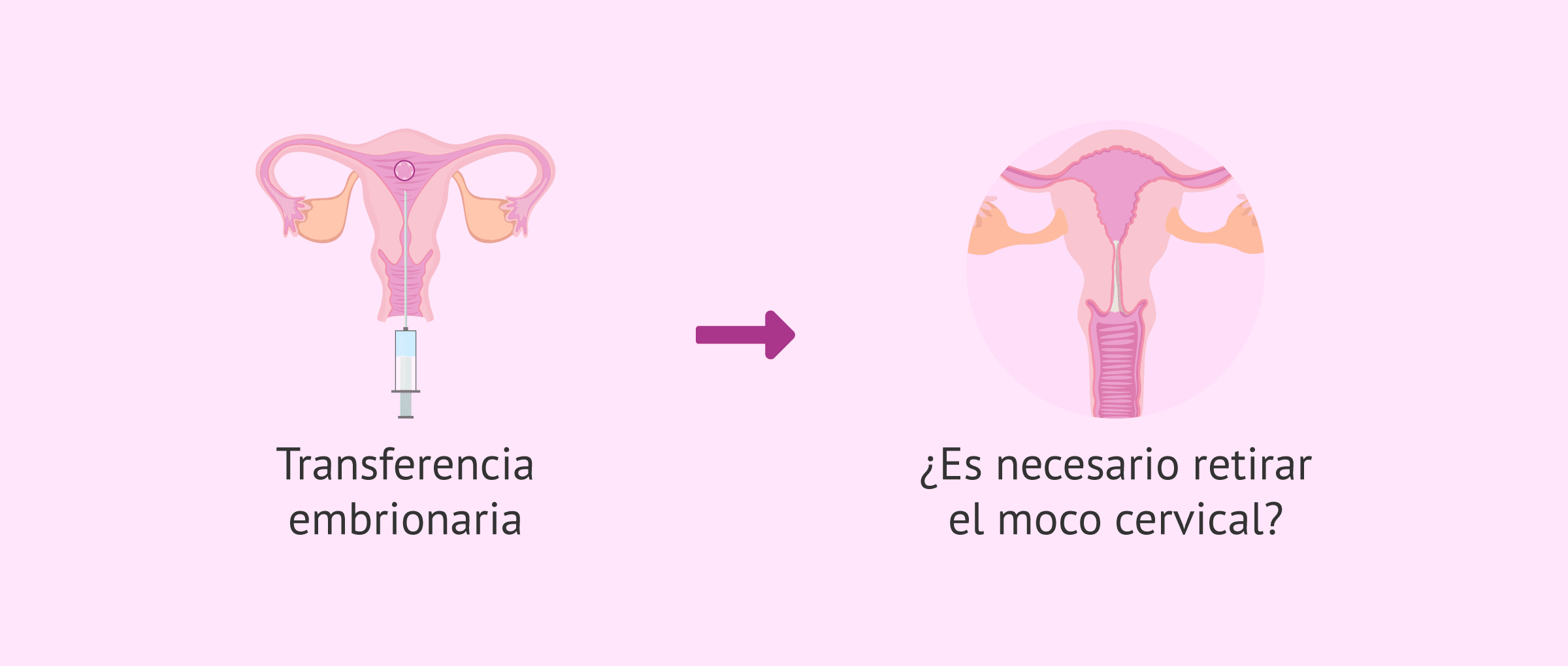 Moco cervical y transferencia embrionaria: ¿afecta al resultado?