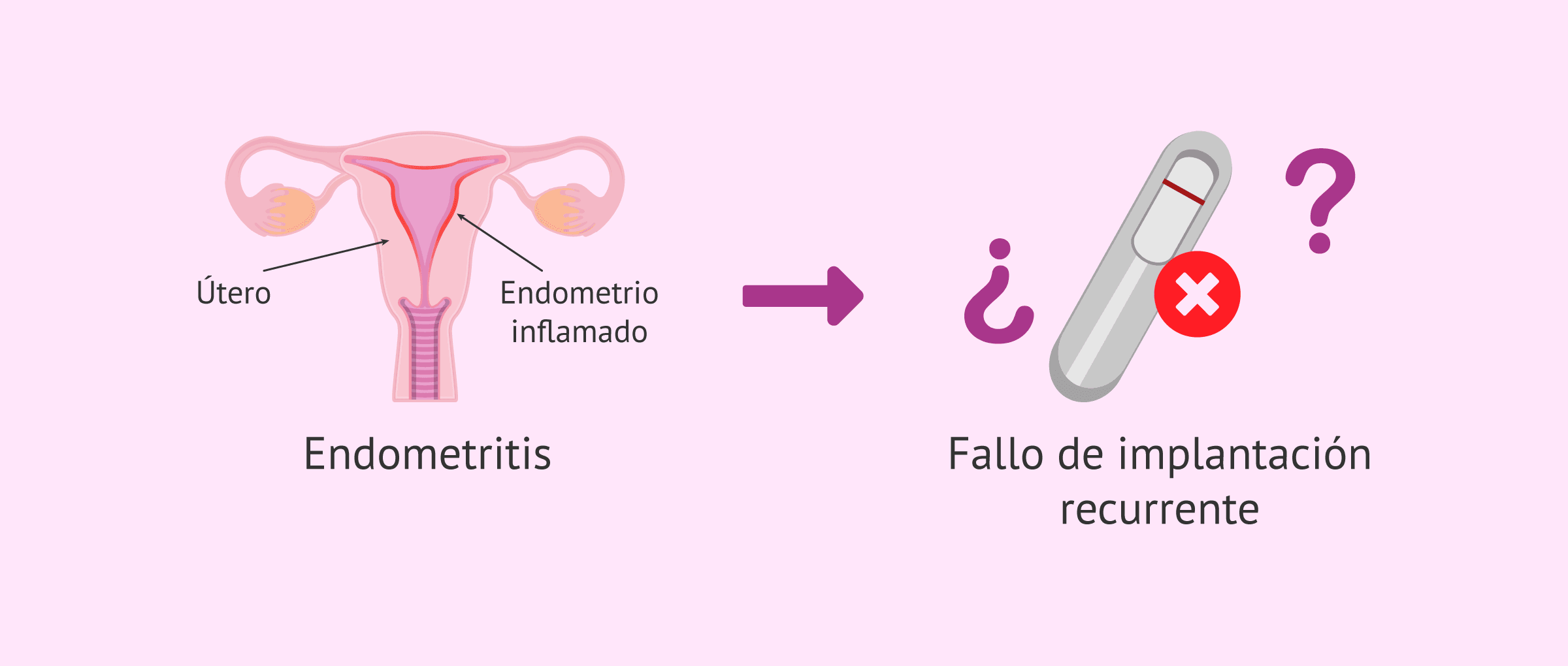 Endometritis crónica: la gran verdad en el fallo de implantación