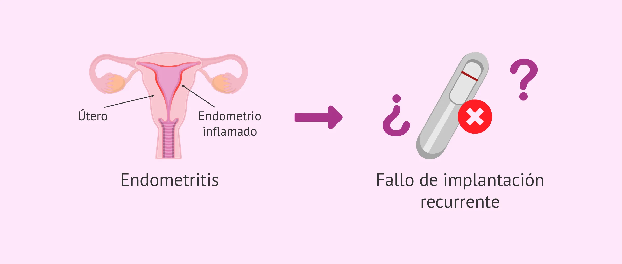 Endometritis crónica: la gran verdad en el fallo de implantación
