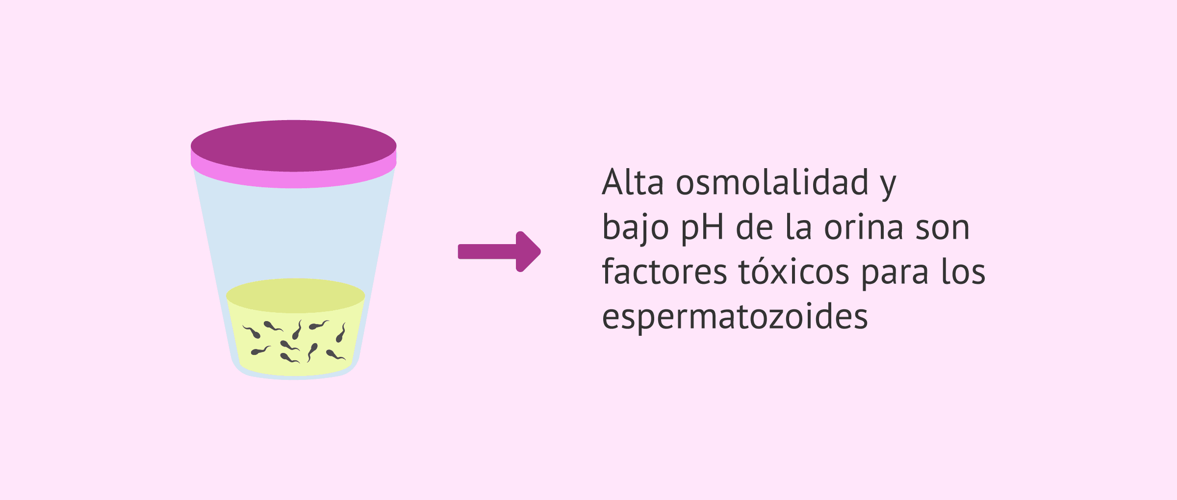 Imagen: Espermatozoides en orina tras eyaculación retrógrada
