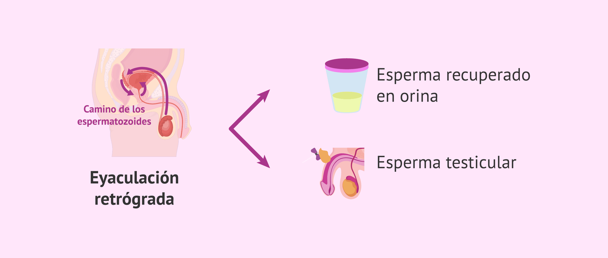 FIV con eyaculación retrógrada: el secreto para lograr el embarazo